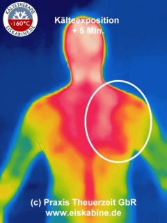 Kälteinduzierte-Stress-Thermografie 